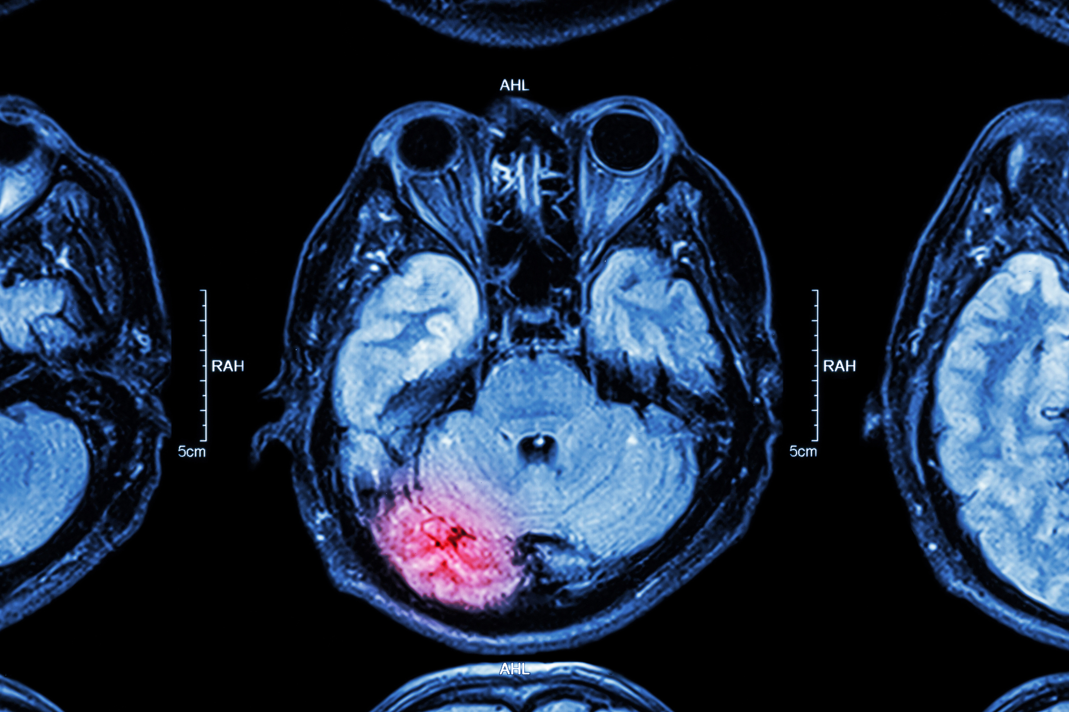 An MRI showing an injured brain