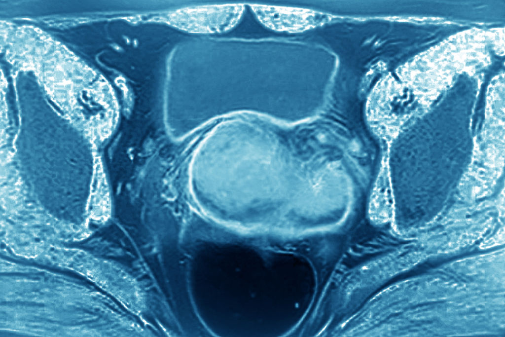 An MRI shows what uterine cancer looks like in a uterus.